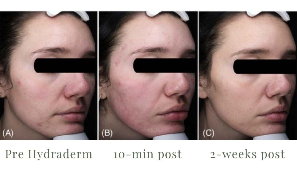 ACE Hydra-dermabrasion Facial