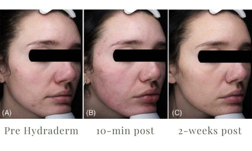 Load image 1 in gallery view. ACE Hydra-dermabrasion Facial