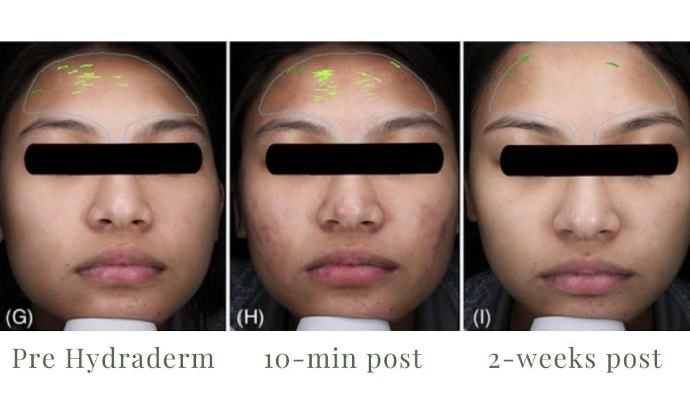 ACE Hydra-dermabrasion Facial