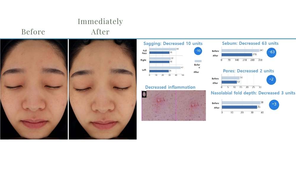 ACE Hydra-dermabrasion Facial
