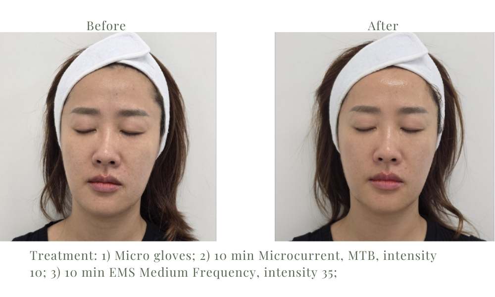 ACE Hydra-dermabrasion Facial