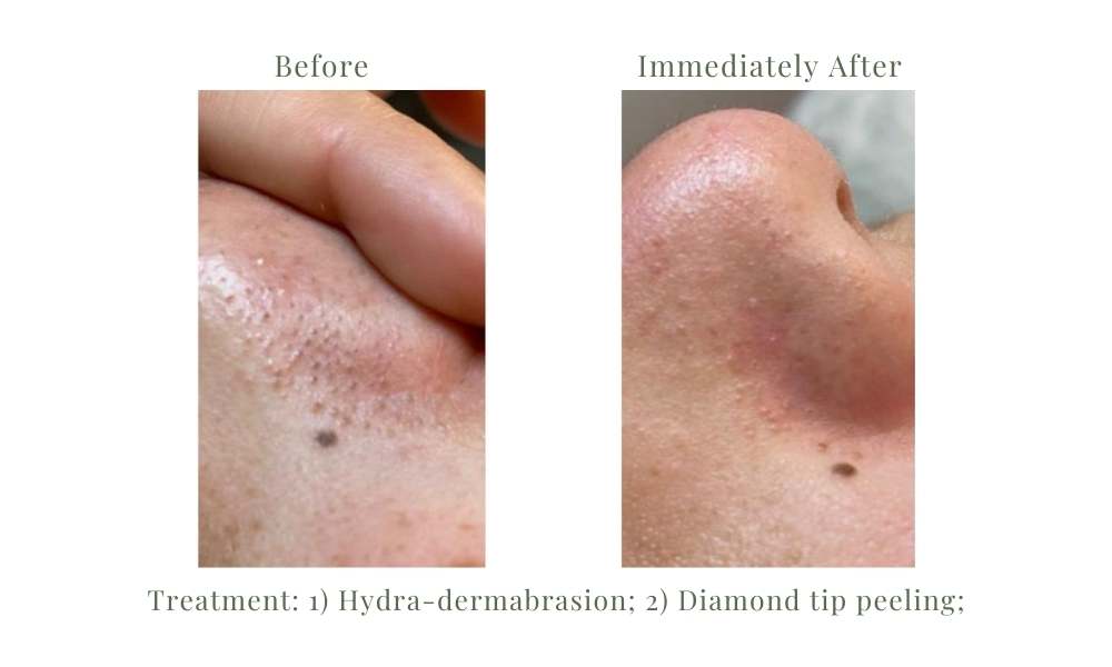 ACE Hydra-dermabrasion Facial