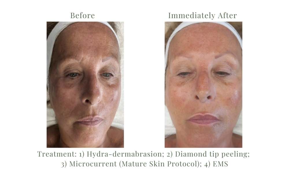 ACE Hydra-dermabrasion Facial