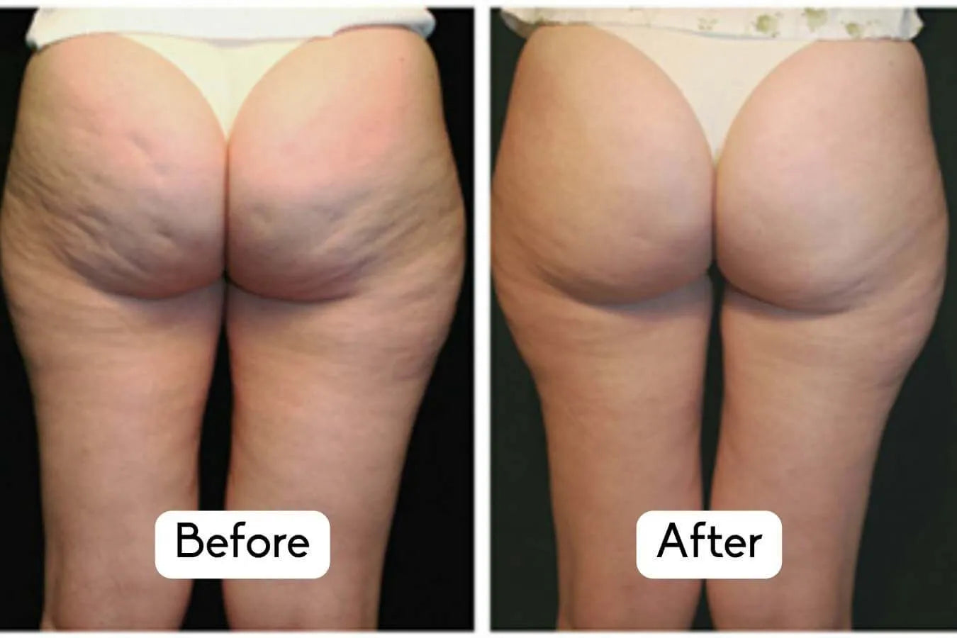 nuFIRM - RF Fascia - Remodeling Body Contouring System