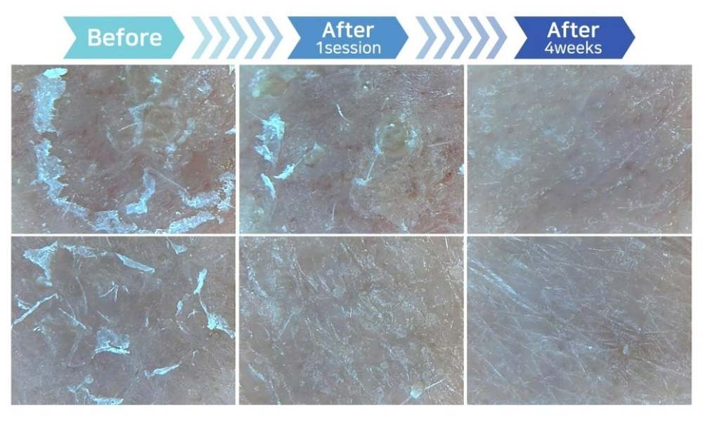 ACE Hydra-dermabrasion Facial