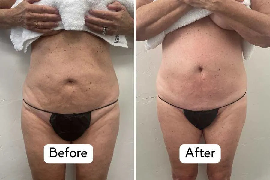 nuFIRM - RF Fascia - Remodeling Body Contouring System