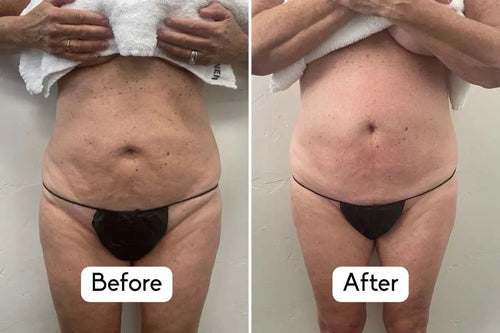 Load image 1 in gallery view. nuFIRM - RF Fascia - Remodeling Body Contouring System
