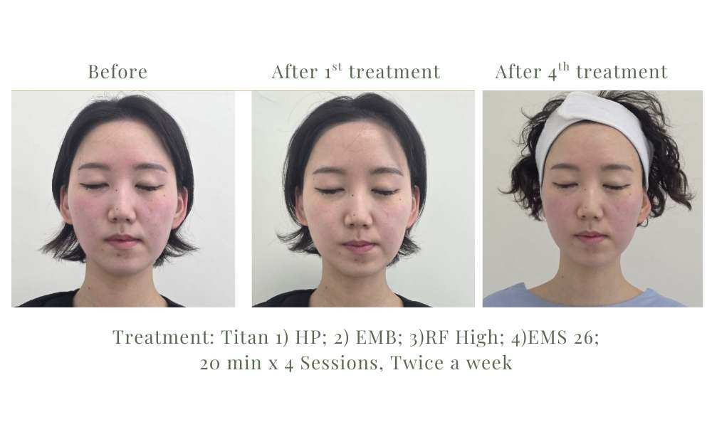 TITAN Facial RF