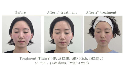 Load image 1 in gallery view. TITAN Facial RF