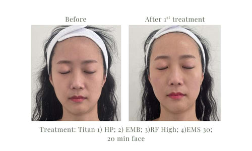 Load image 1 in gallery view. TITAN Facial RF