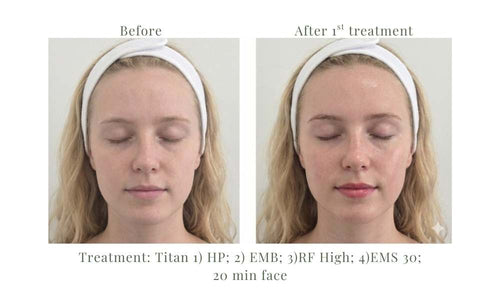 Load image 1 in gallery view. TITAN Facial RF