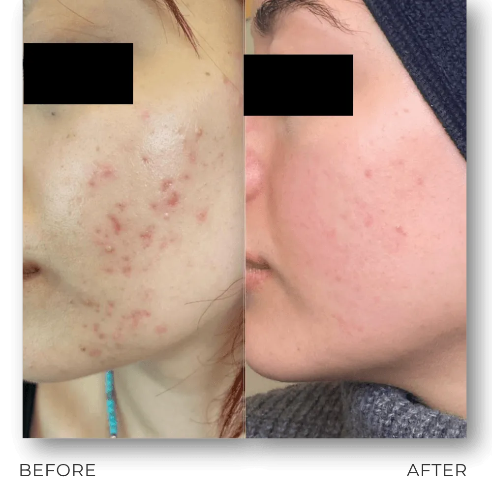 SILRKO – Premium RF Microneedling & Cold Plasma Platform