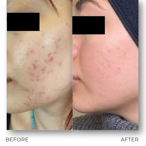 Load image 1 in gallery view. SILRKO – Premium RF Microneedling & Cold Plasma Platform