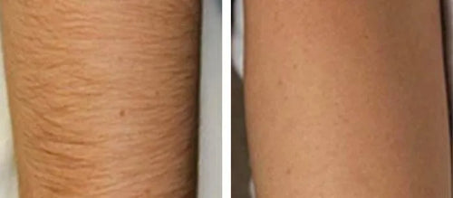 Load image 1 in gallery view. nuSILK - AI- Powered Diode Laser Hair Removal Platform