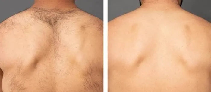 nuSILK - AI- Powered Diode Laser Hair Removal Platform