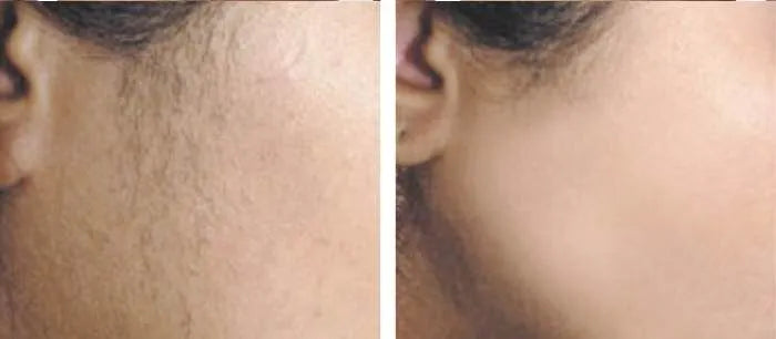 nuSILK - AI- Powered Diode Laser Hair Removal Platform