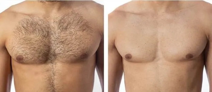 nuSILK - AI- Powered Diode Laser Hair Removal Platform