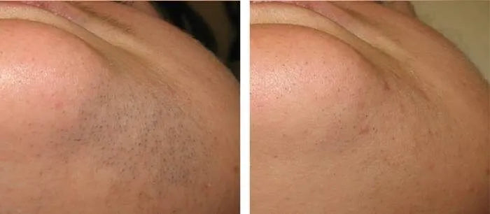 nuSILK - AI- Powered Diode Laser Hair Removal Platform