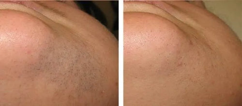Load image 1 in gallery view. nuSILK - AI- Powered Diode Laser Hair Removal Platform