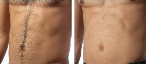 Load image 1 in gallery view. nuSILK - AI- Powered Diode Laser Hair Removal Platform