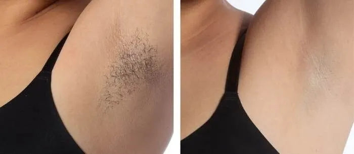 nuSILK - AI- Powered Diode Laser Hair Removal Platform