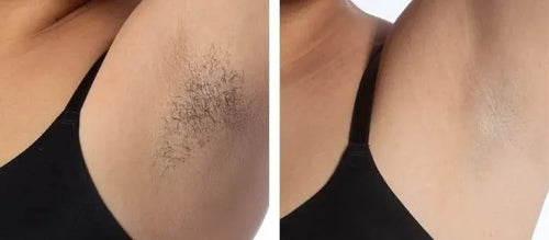 Load image 1 in gallery view. nuSILK - AI- Powered Diode Laser Hair Removal Platform